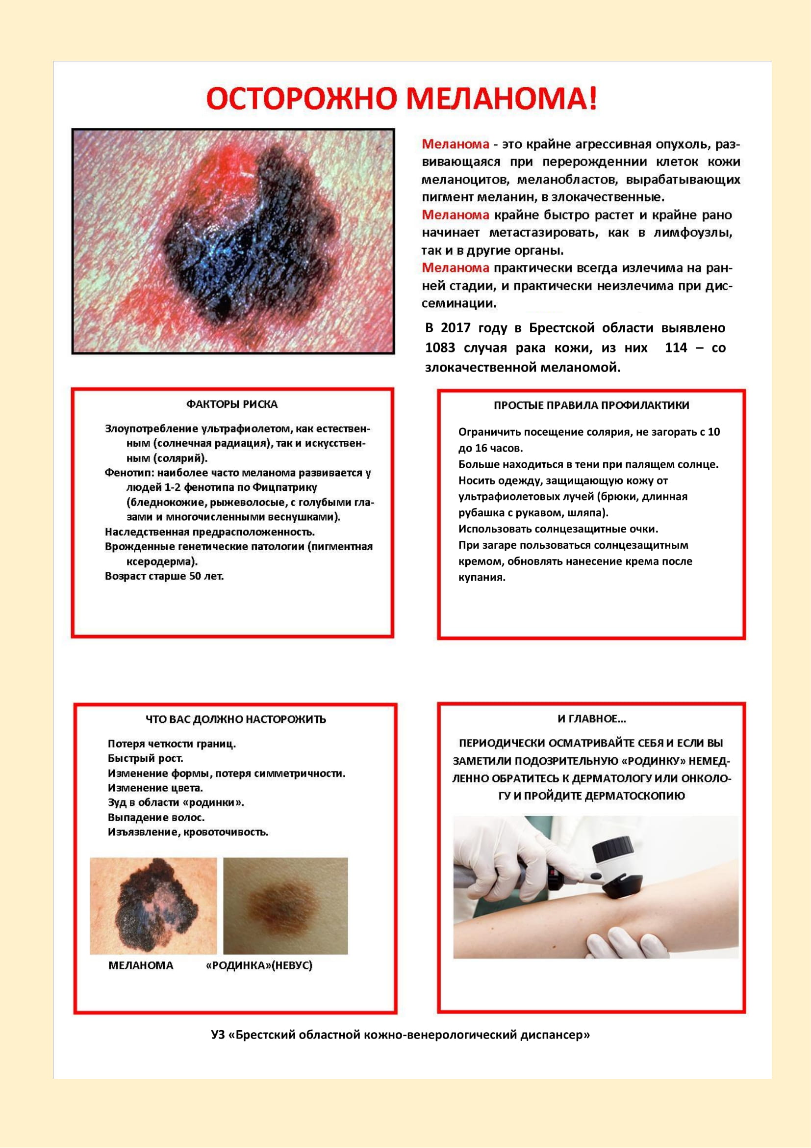 melanoma info